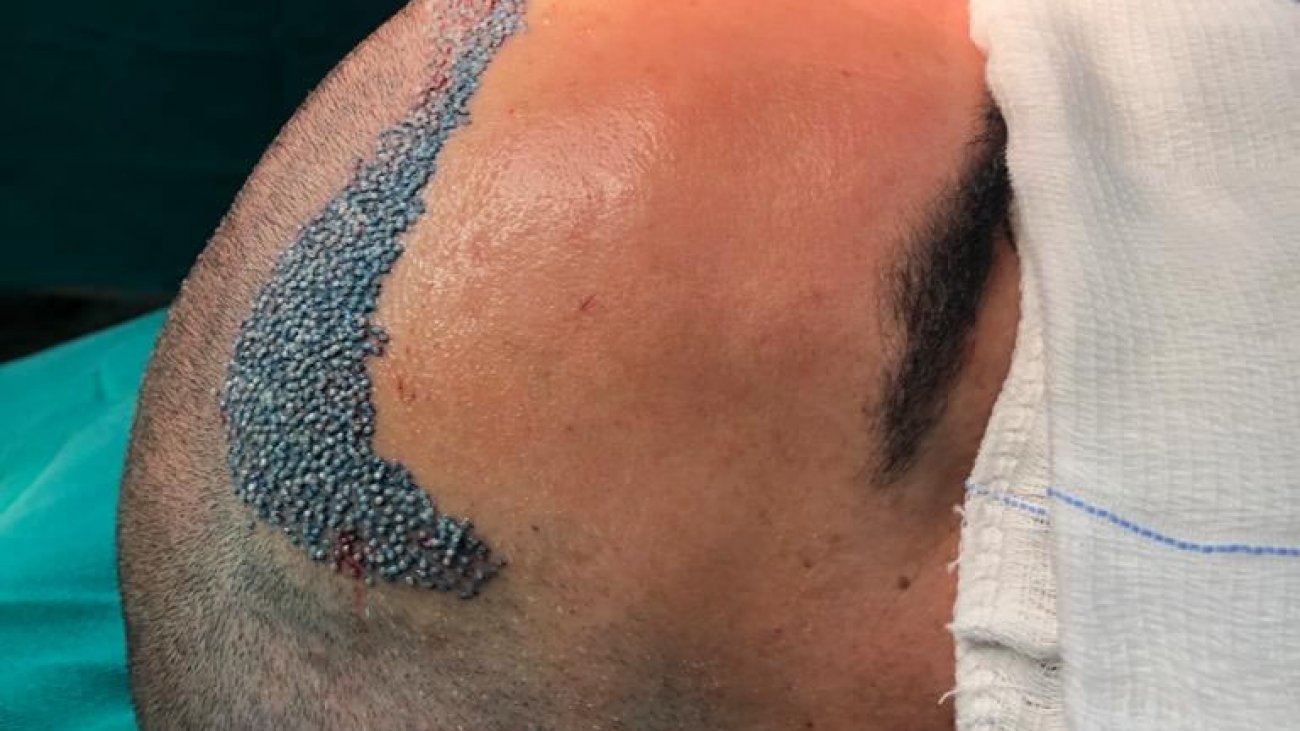 especialista em transplante capilar ribeirão preto