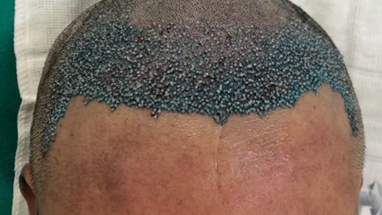 transplante capilar cirurgia em ribeirão preto