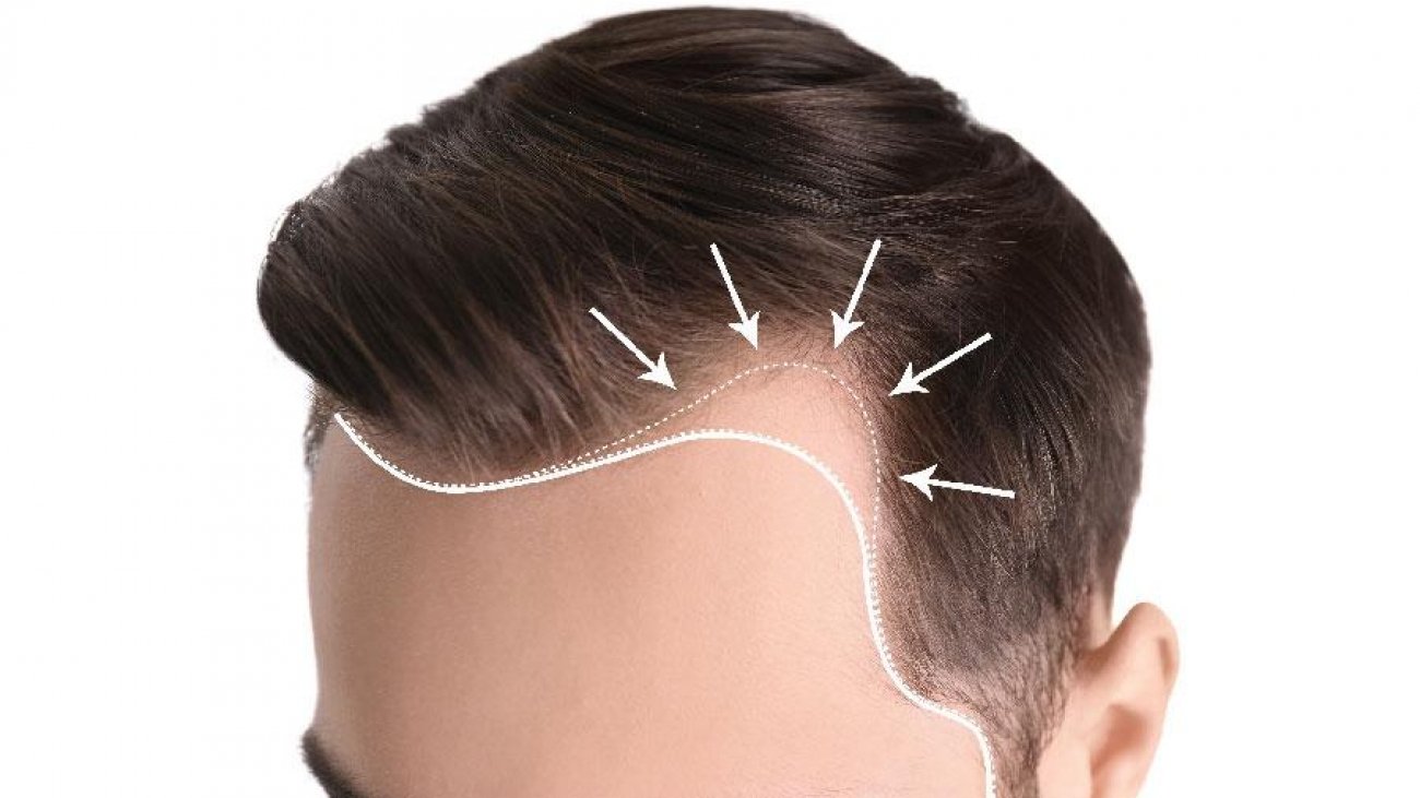 hairline transplante capilar