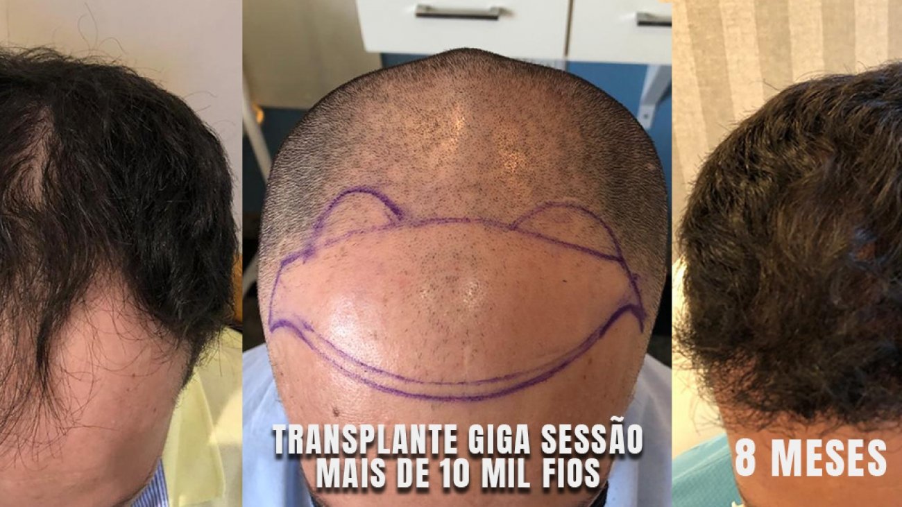 transplante capilar fue antes e depois ribeirao preto