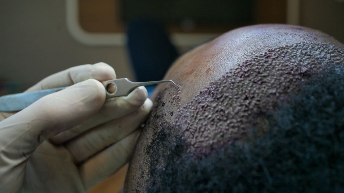 Transplante Capilar em Ribeirão Preto Como é depois do transplante capilar