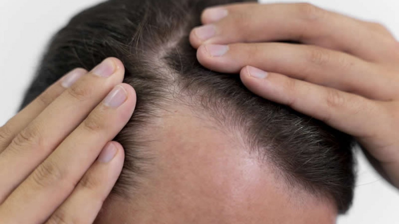 Entrada no cabelo Quais são as suas causas e como tratar Transplante capilar Ribeirão Preto