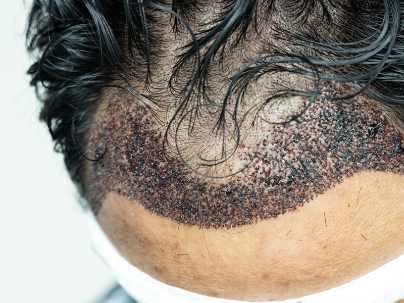 O que acontece depois do implante capilar transplante de cabelos em ribeirão preto