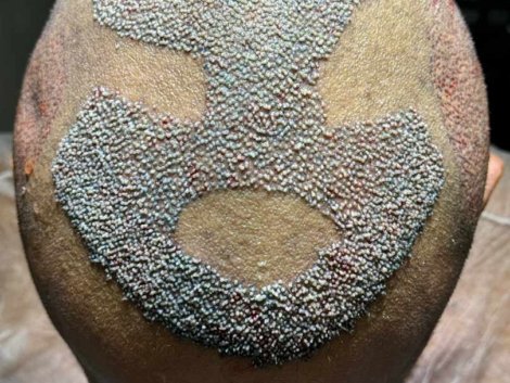 O que acontece após um transplante capilar