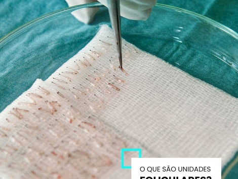 Transplante Capilar Ribeirão Preto O que são unidades foliculares