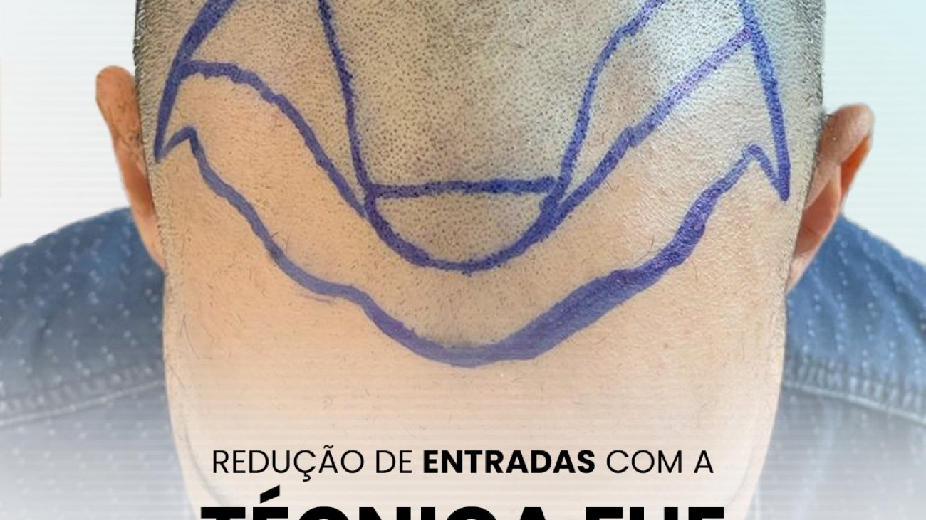 transplante capilar fue em ribeirão preto