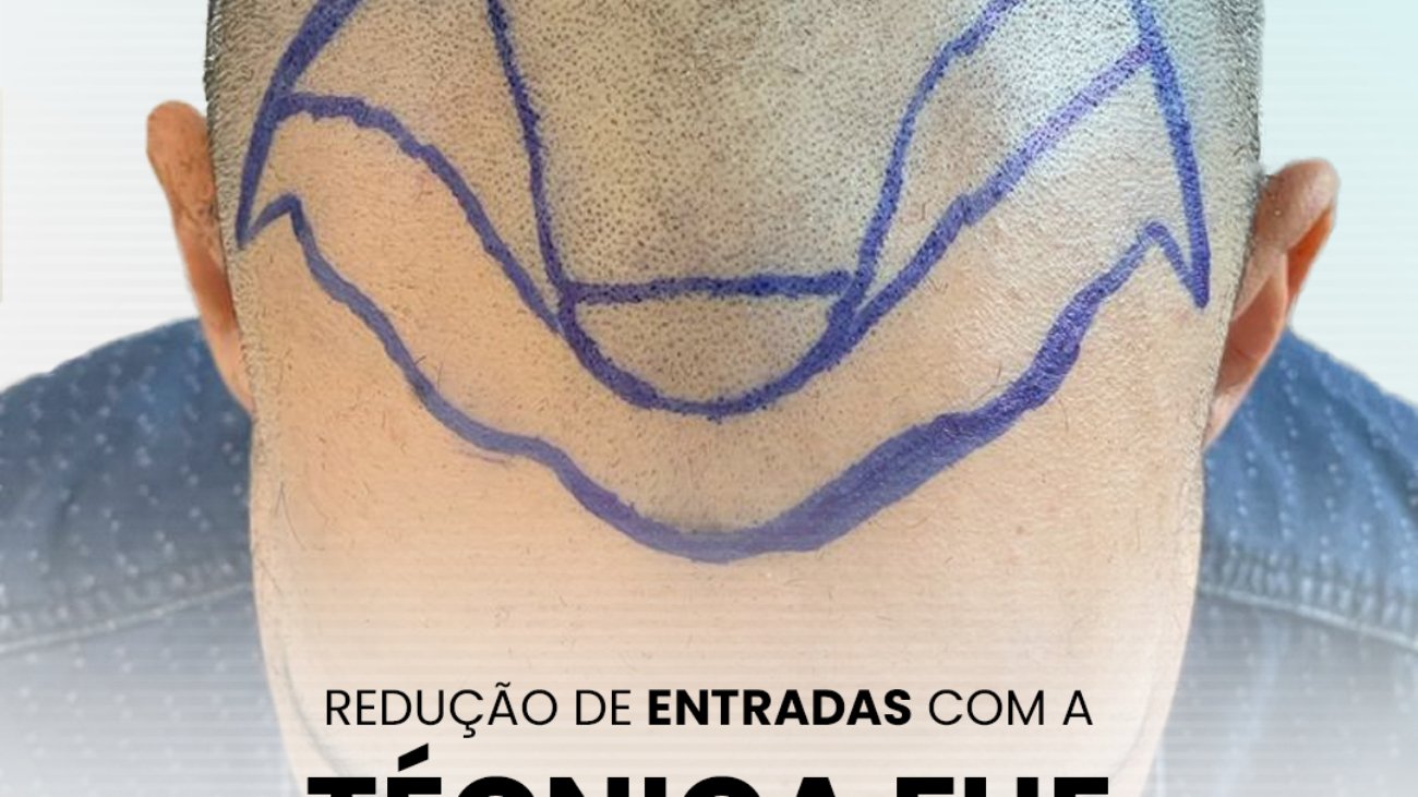 Prenda um Cpouco Mais Sobre a Técnica FUE