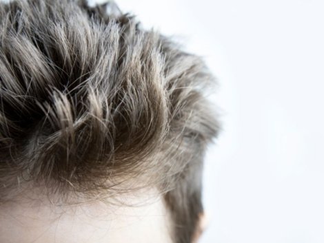 Transplante Capilar em Ribeirão Preto com Resultado Natural