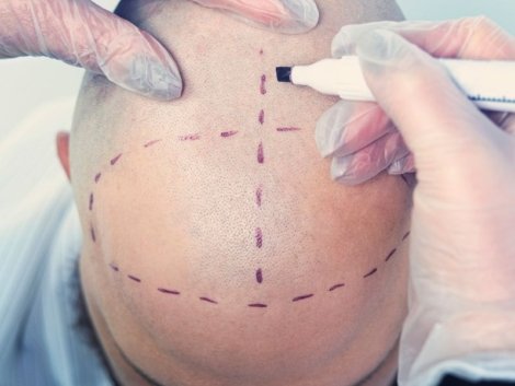 Tudo sobre as Marcações no Transplante Capilar em Ribeirão Preto