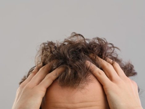 A Importância da Hairline no Transplante Capilar