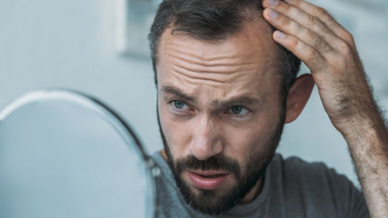 Alopecia Areata Tratando a Perda de Cabelo em Ribeirão Preto