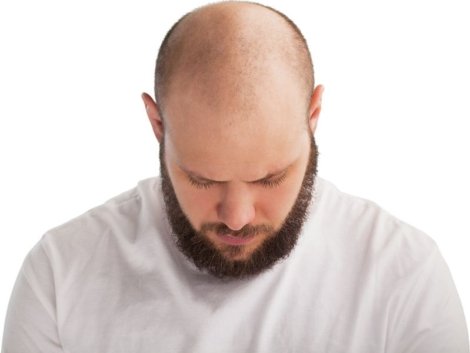 Como é a técnica de TRANSPLANTE CAPILAR FIO A FIO (FUE)