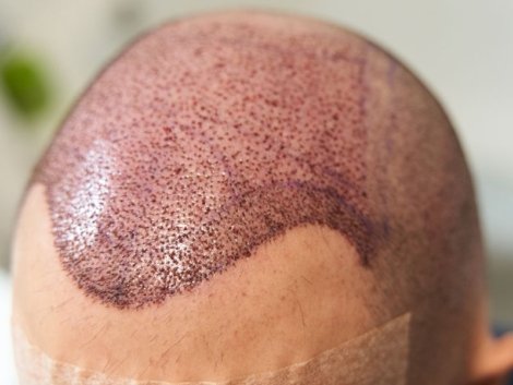 Técnica de Cirurgia Capilar FUE em Ribeirão Preto_ Uma Revolução para seus Cabelos