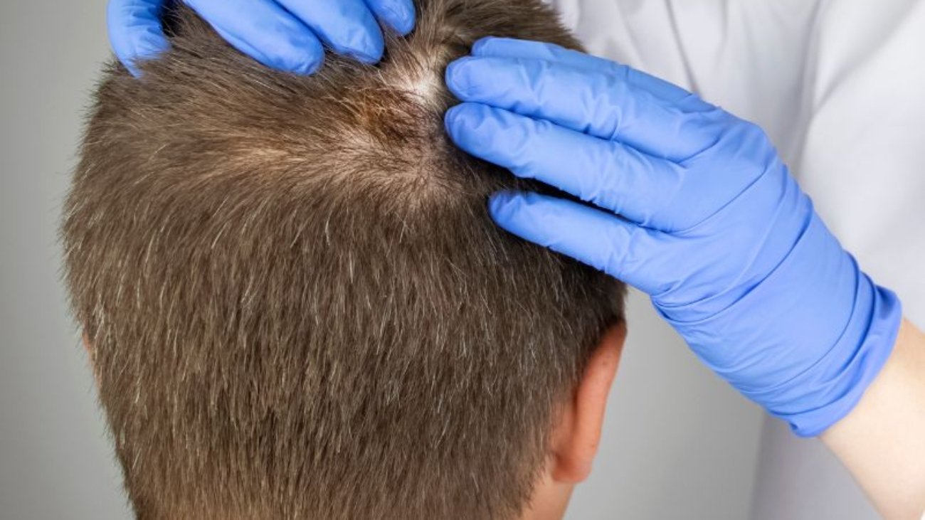 Transplante Capilar FIO A FIO (FUE) Uma Solução Moderna para a Calvície