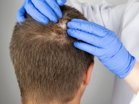 Transplante Capilar FIO A FIO (FUE) Uma Solução Moderna para a Calvície