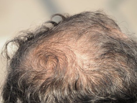 Transplante Capilar em Ribeirão Preto_ A Solução para a Calvície