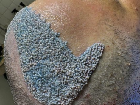 redução de testa com transplante capilar de altissima densidade