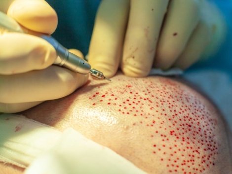 A Tecnologia por Trás da Técnica FUE Capilar