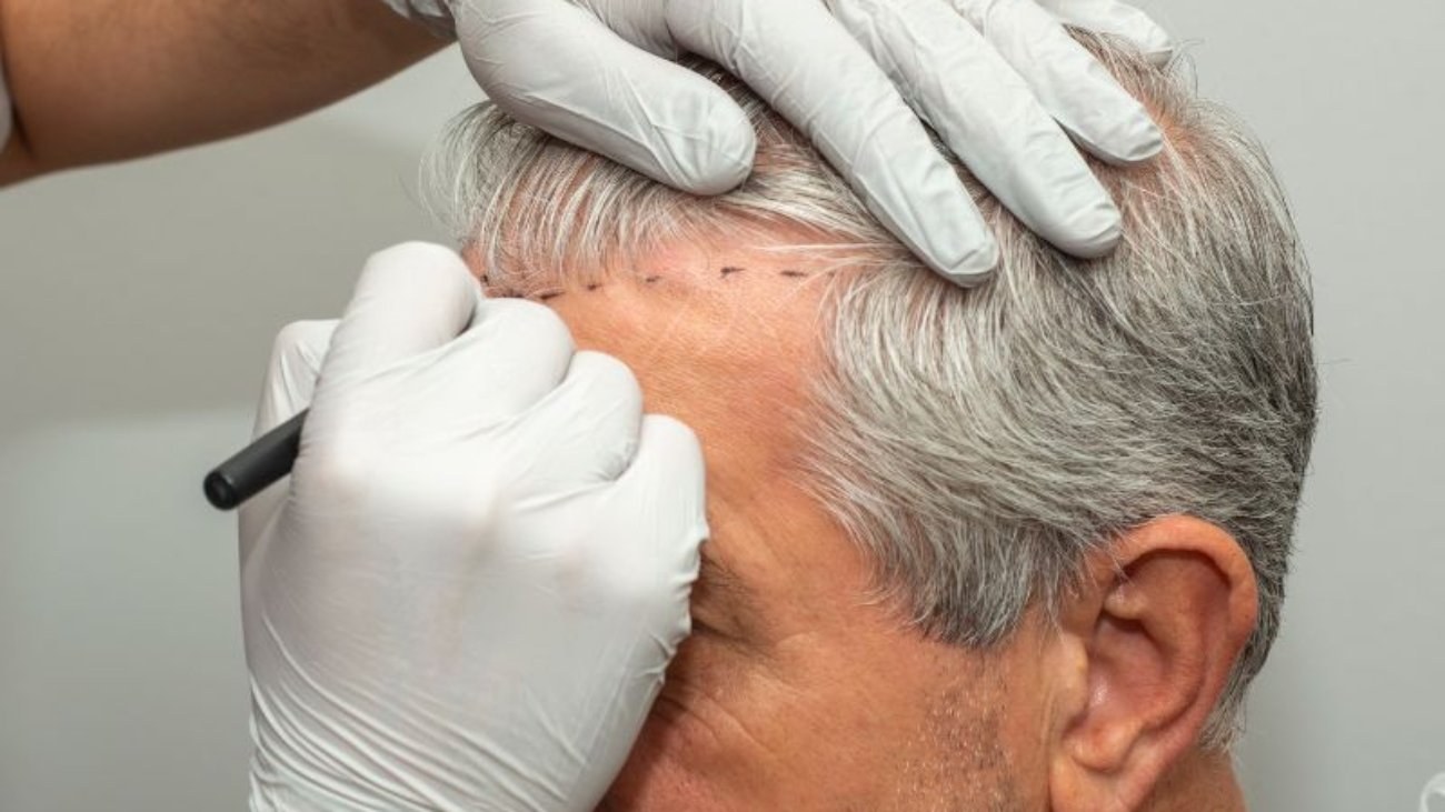 Como a Microinfusão Capilar Combate a Queda de Cabelo