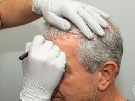 Como a Microinfusão Capilar Combate a Queda de Cabelo