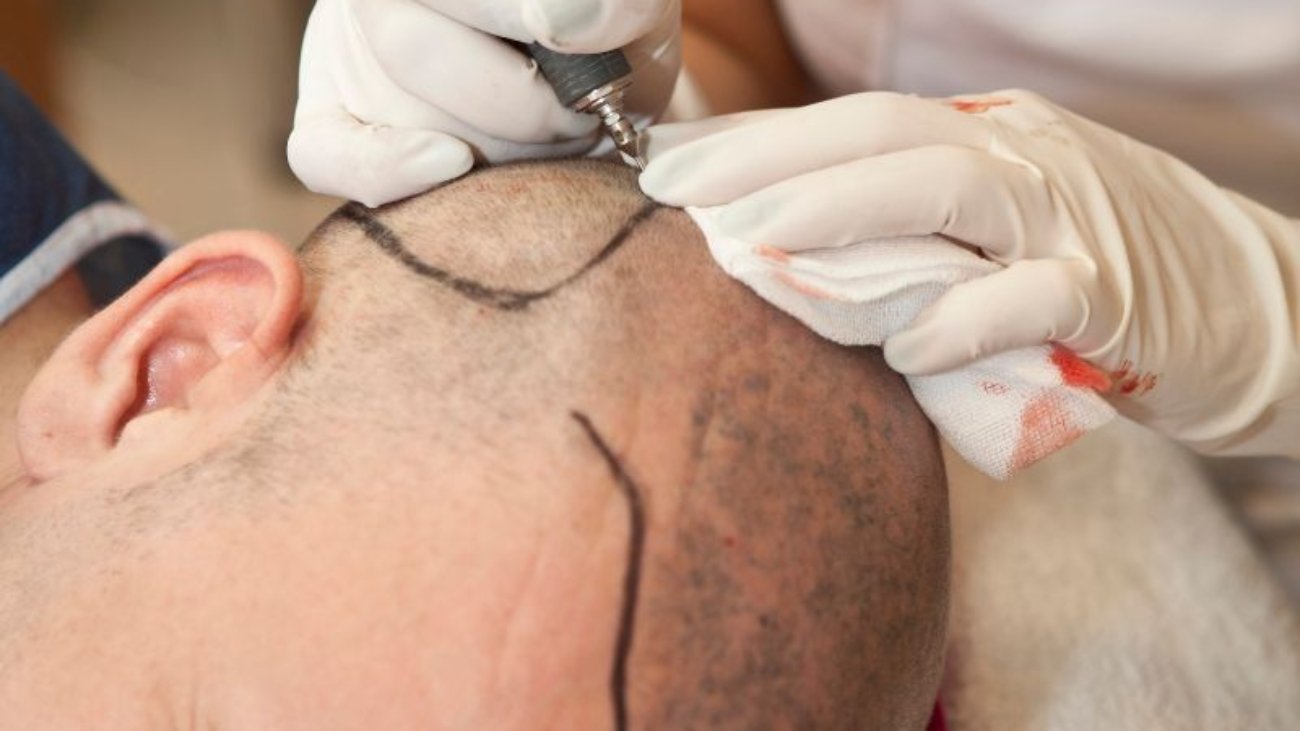 Entenda o Processo do Transplante Capilar Moderno