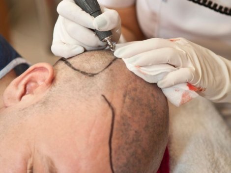 Entenda o Processo do Transplante Capilar Moderno