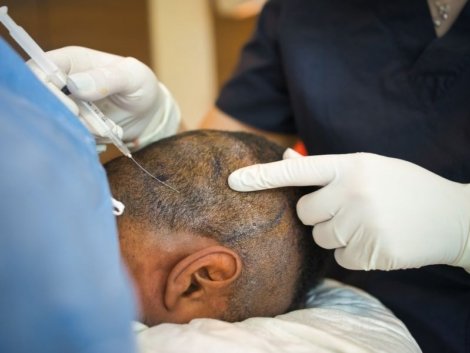 Técnica FUE A Revolução do Transplante Capilar