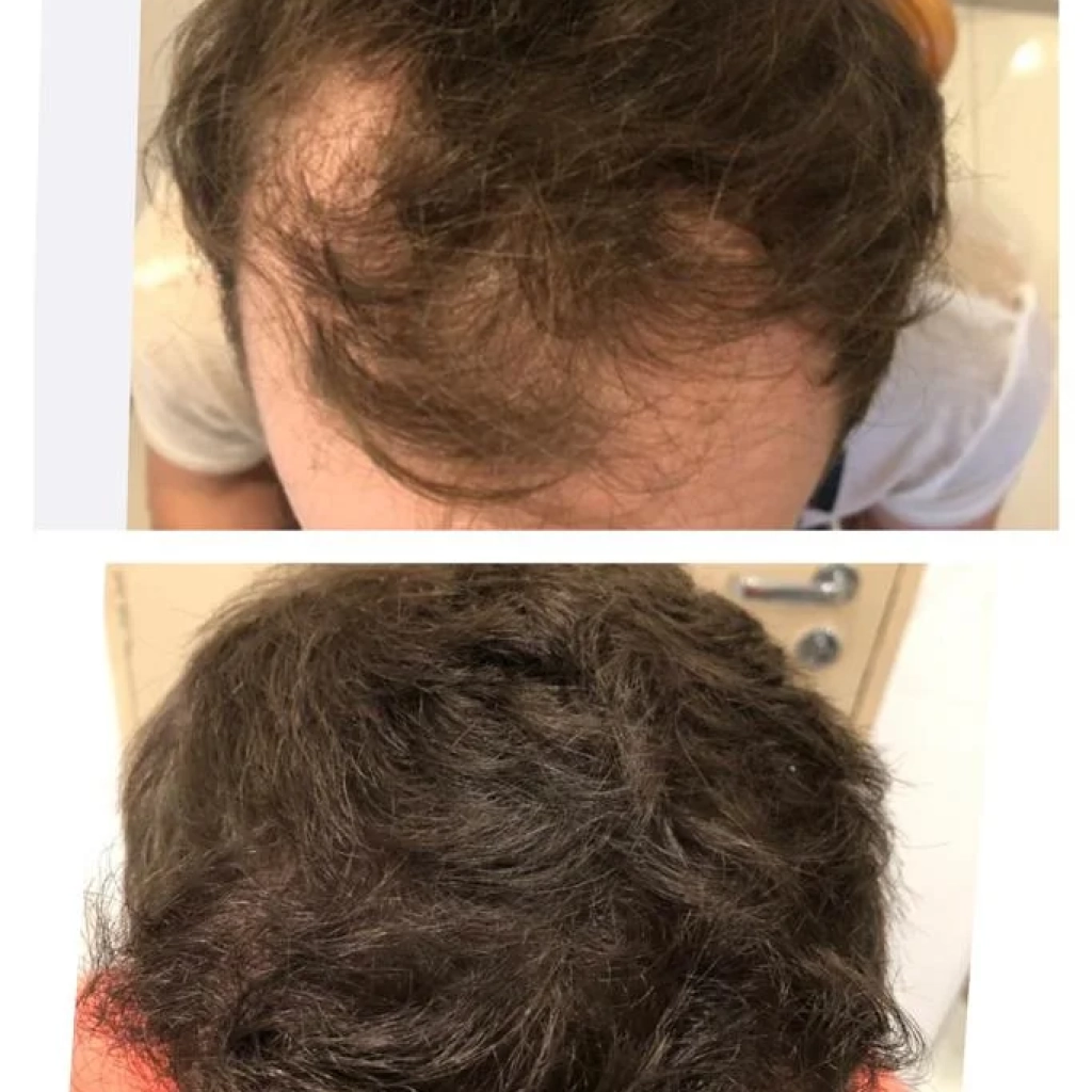 Alopecia Androgenética em Ribeirão Preto Diagnóstico, Tratamentos e Soluções Definitivas