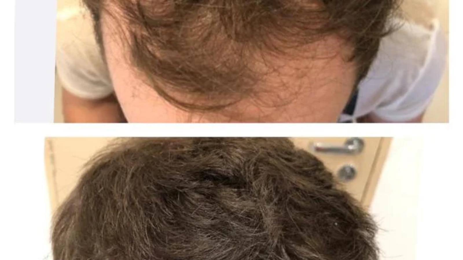 Alopecia Androgenética em Ribeirão Preto Diagnóstico, Tratamentos e Soluções Definitivas