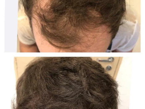 Alopecia Androgenética em Ribeirão Preto Diagnóstico, Tratamentos e Soluções Definitivas
