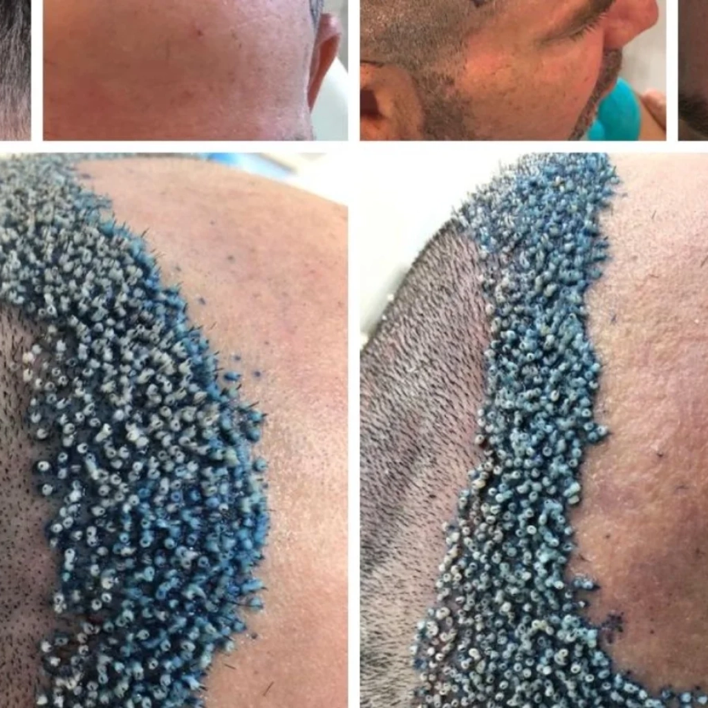 Antes e Depois do Transplante Capilar em Ribeirão Preto O Que Esperar dos Resultados