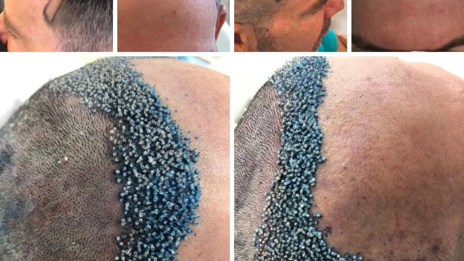 Antes e Depois do Transplante Capilar em Ribeirão Preto O Que Esperar dos Resultados
