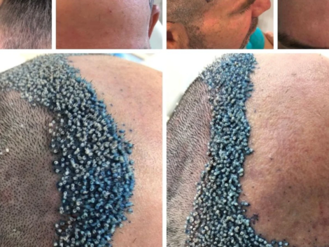 Antes e Depois do Transplante Capilar em Ribeirão Preto O Que Esperar dos Resultados