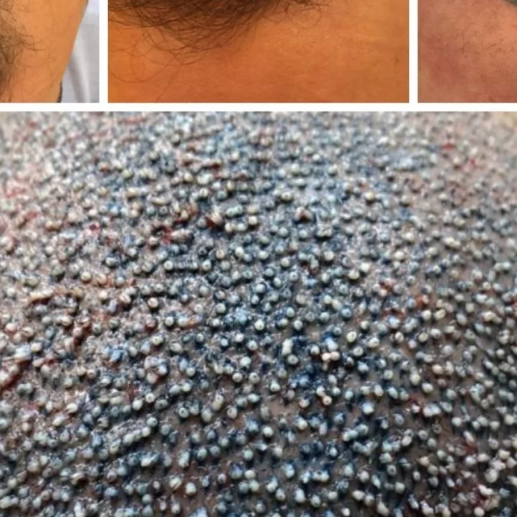 Hairline no Transplante Capilar em Ribeirão Preto O Segredo do Resultado Natural
