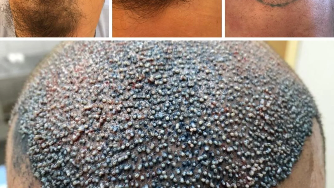 Hairline no Transplante Capilar em Ribeirão Preto O Segredo do Resultado Natural