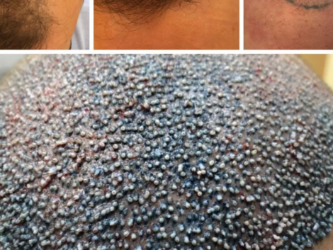 Hairline no Transplante Capilar em Ribeirão Preto O Segredo do Resultado Natural