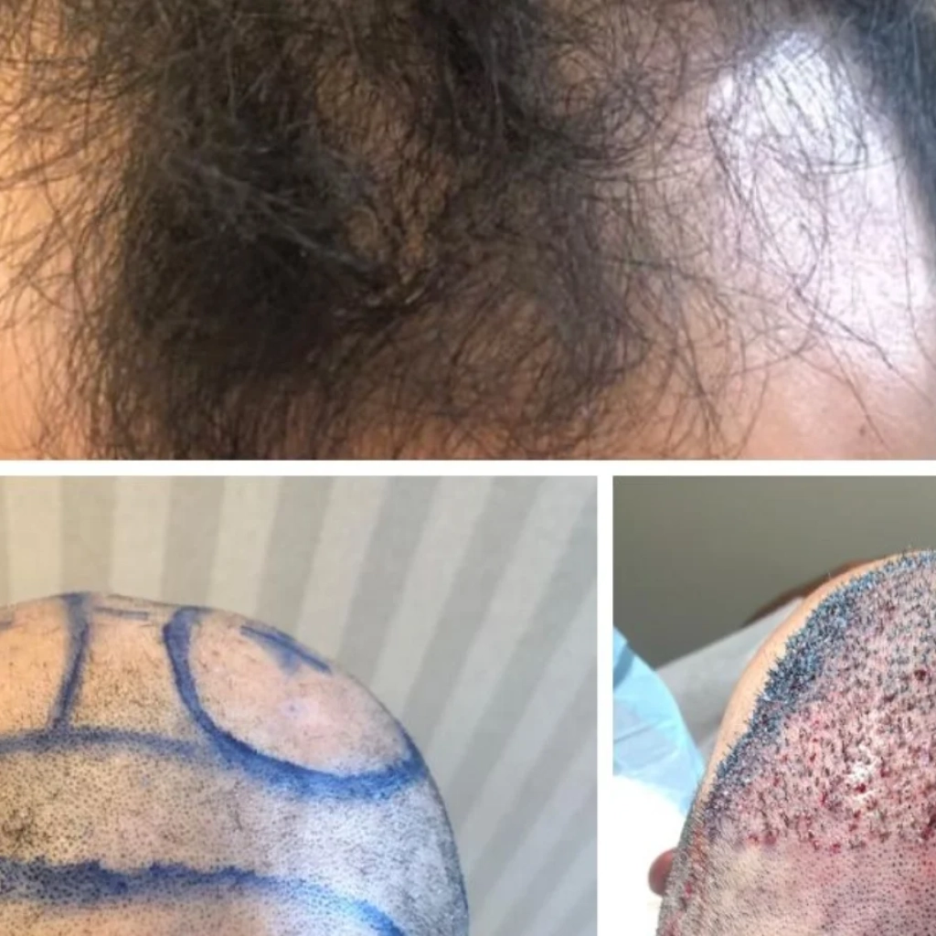 Recuperação Após Transplante Capilar FUE em Ribeirão Preto Cuidados e Tempo de Retorno