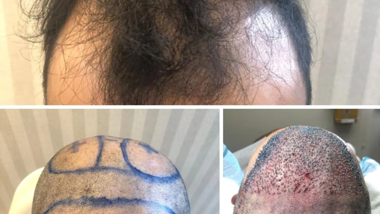 Recuperação Após Transplante Capilar FUE em Ribeirão Preto Cuidados e Tempo de Retorno
