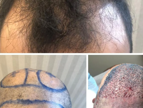 Recuperação Após Transplante Capilar FUE em Ribeirão Preto Cuidados e Tempo de Retorno