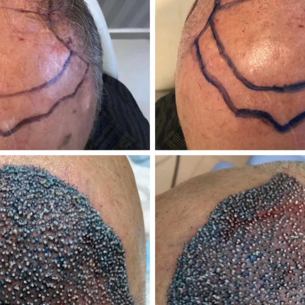 Transplante Capilar Masculino em Ribeirão Preto Quando é o Momento Certo para Fazer