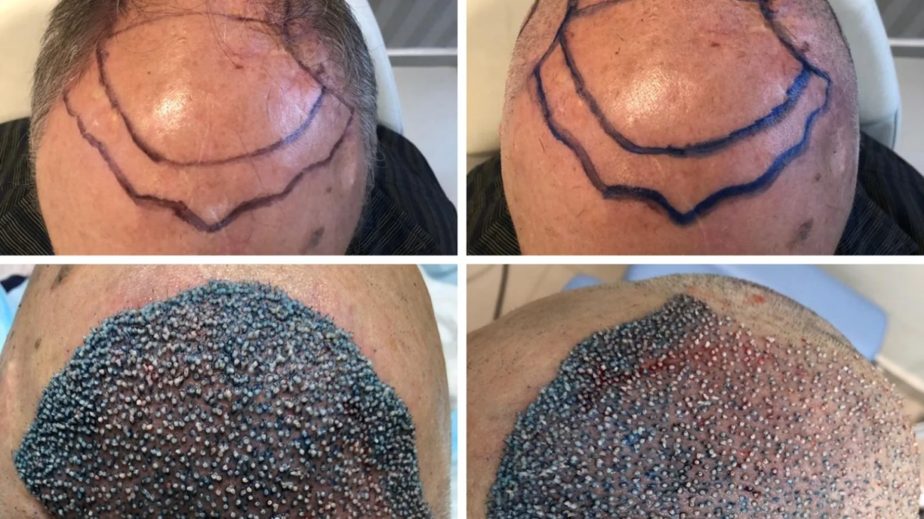 Transplante Capilar Masculino em Ribeirão Preto Quando é o Momento Certo para Fazer