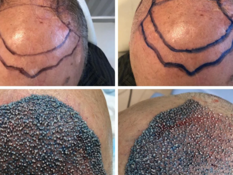 Transplante Capilar Masculino em Ribeirão Preto Quando é o Momento Certo para Fazer