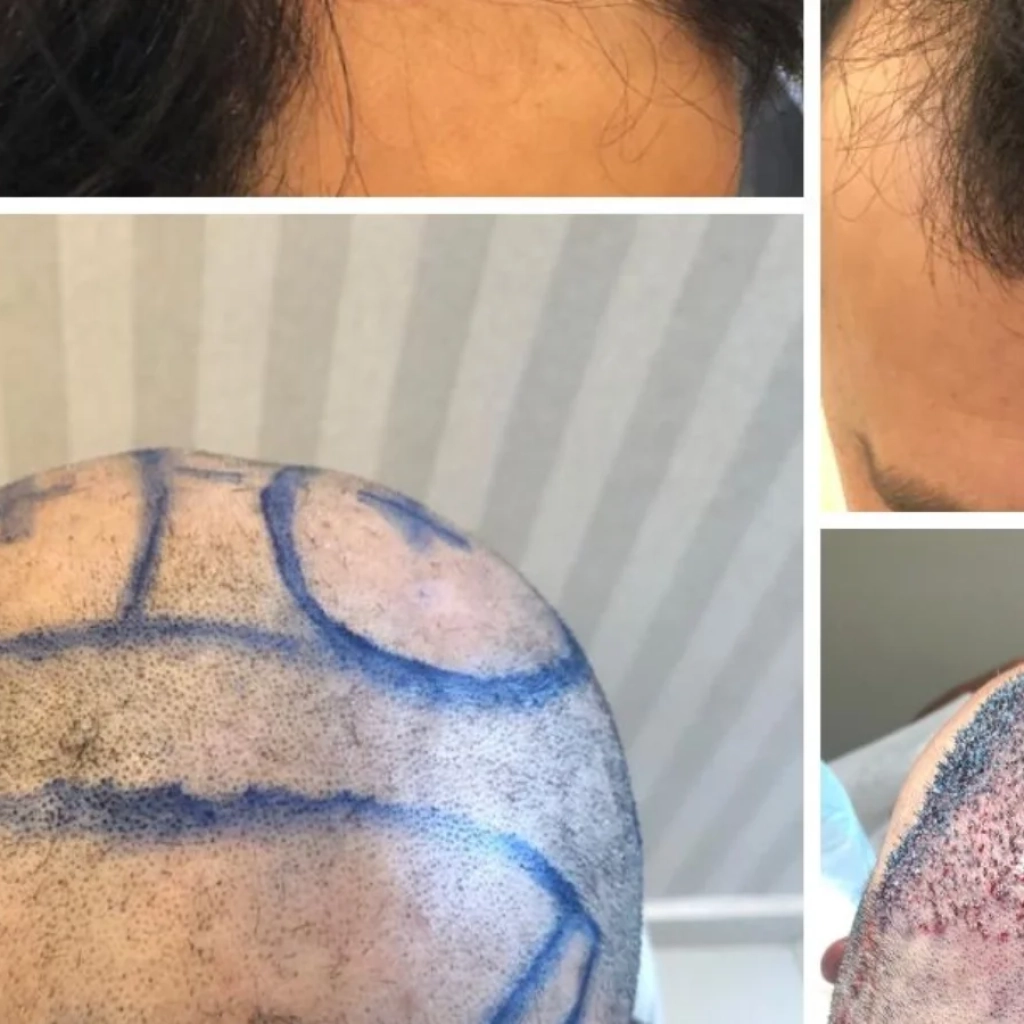 Transplante Capilar em Ribeirão Preto Valor, Técnica FUE e Resultados Reais