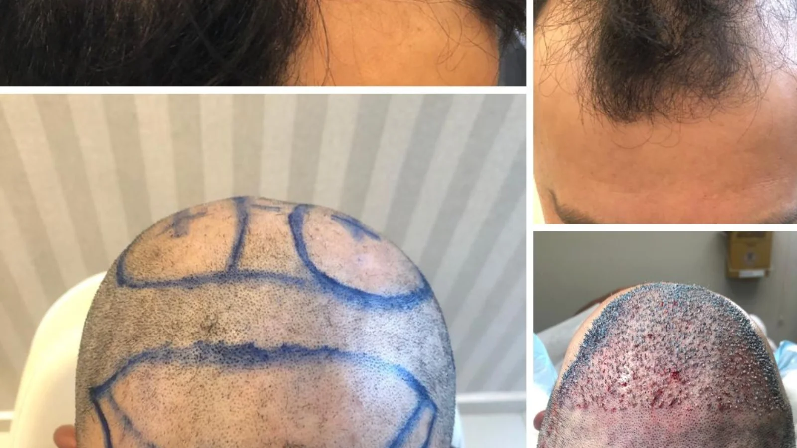 Transplante Capilar em Ribeirão Preto Valor, Técnica FUE e Resultados Reais