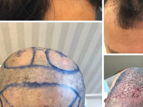 Transplante Capilar em Ribeirão Preto Valor, Técnica FUE e Resultados Reais