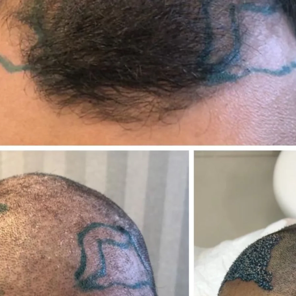 Transplante de Barba em Ribeirão Preto Como Funciona e Quem Pode Fazer
