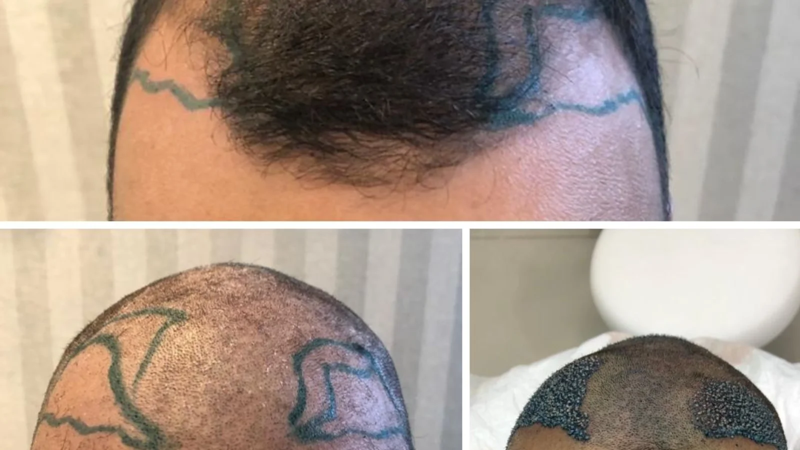 Transplante de Barba em Ribeirão Preto Como Funciona e Quem Pode Fazer