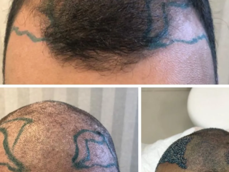 Transplante de Barba em Ribeirão Preto Como Funciona e Quem Pode Fazer