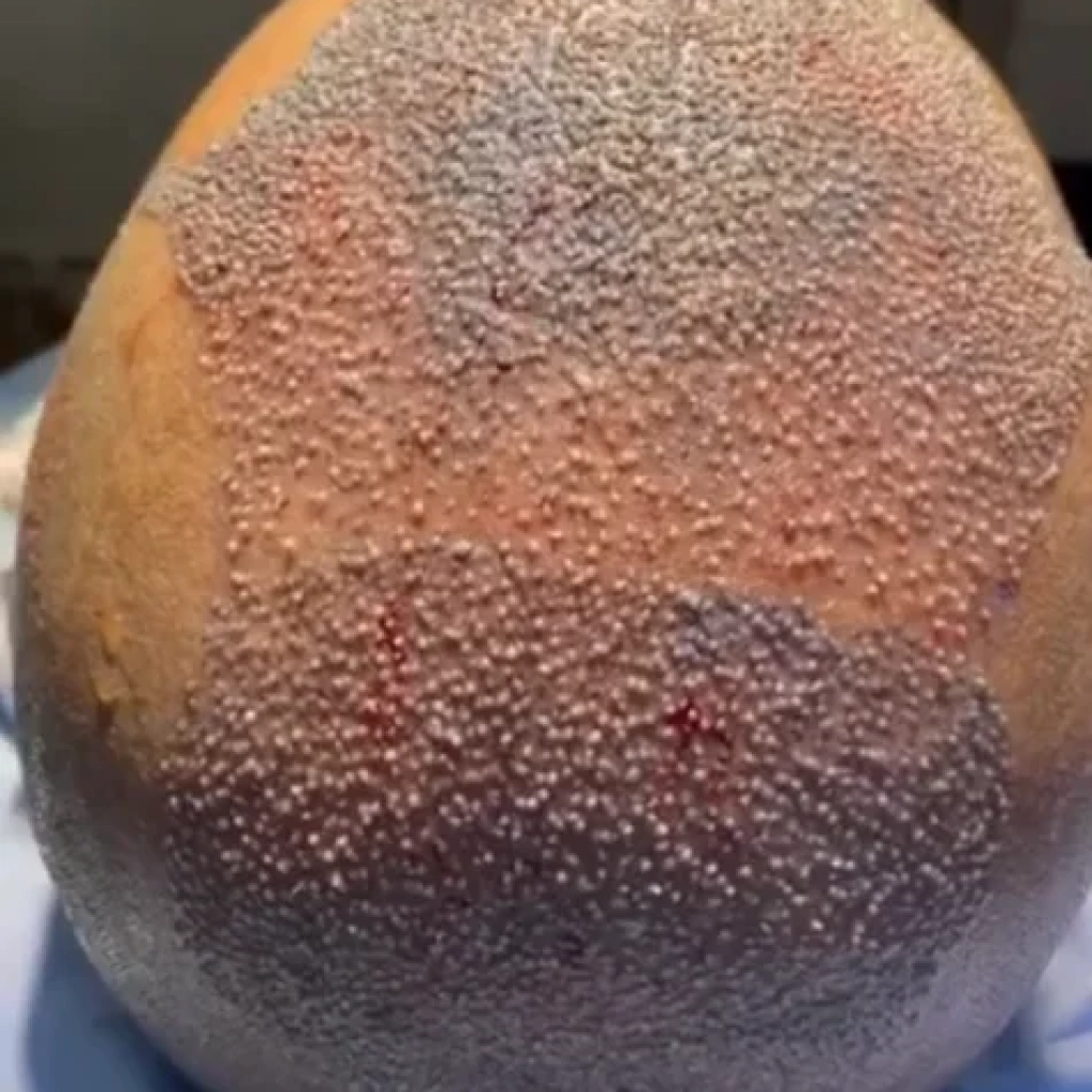 Tratamentos Capilares em Ribeirão Preto Quando o Transplante Não é o Primeiro Passo