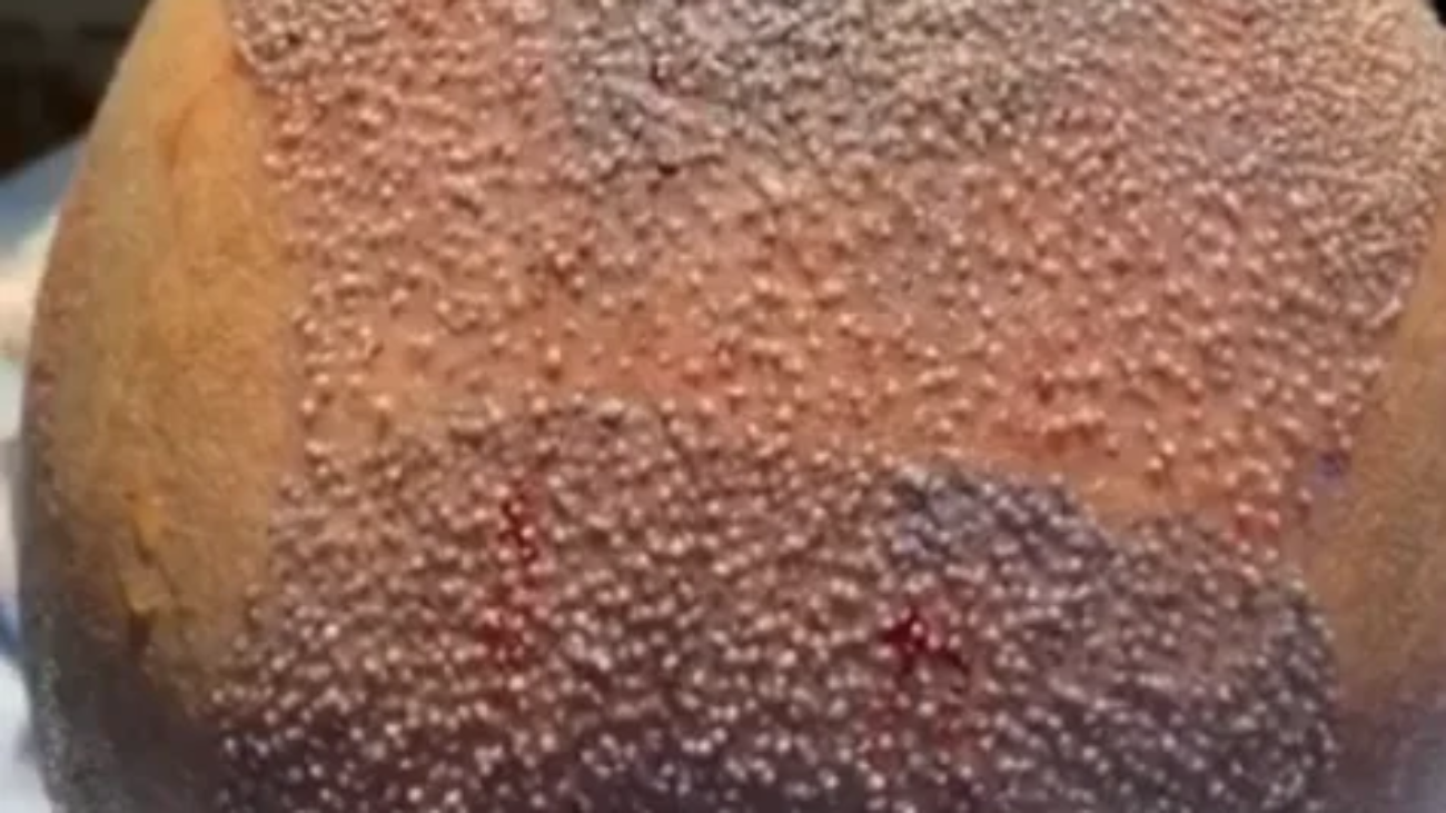 Tratamentos Capilares em Ribeirão Preto Quando o Transplante Não é o Primeiro Passo